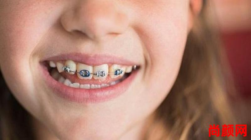 12岁孩子矫正牙齿需要多久;12岁孩子矫正牙齿需要多久,要多少钱