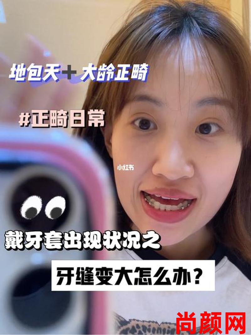 17岁拔牙戴牙套带多久—17岁拔牙戴牙套带多久好