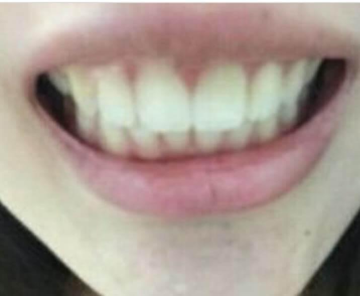 广州越秀圣贝口腔赵艳明牙齿美白的真实案例！