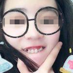 广东省口腔医院高峰牙齿矫正案例分享