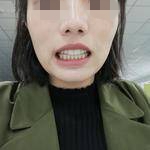 广州优雅联合口腔门诊部谭小恩牙齿矫正案例
