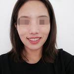 广州优雅联合口腔门诊部谭小恩牙齿矫正案例