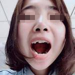 杭州雅莱口腔医院张晓晴牙齿矫正案例