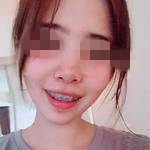 杭州雅莱口腔医院张晓晴牙齿矫正案例
