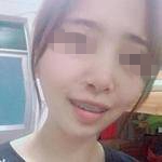杭州雅莱口腔医院张晓晴牙齿矫正案例