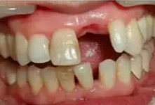 广州雅度口腔医院许辉红牙齿种植真实案例分享