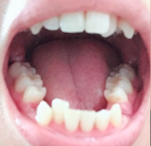 广州圣贝口腔医院张修学隐形牙齿矫正真实案例分享