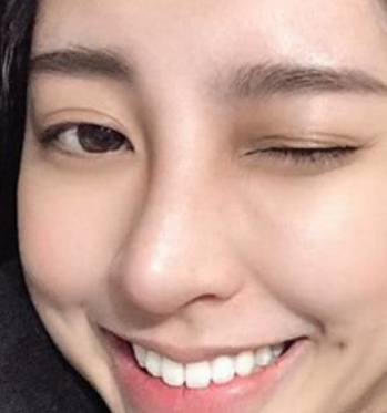 南方医科大学口腔医院宋保光牙齿美白案例来啦！