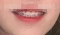 广州越秀圣贝口腔孙风阳牙齿矫正案例分享来咯~