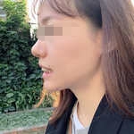 杭州雅莱口腔医院胡靖宇牙齿矫正案例