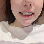 杭州雅莱口腔医院胡靖宇牙齿矫正案例