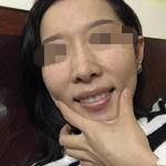 北京首都医科大学附属北京口腔医院董辉牙齿矫正案例分享
