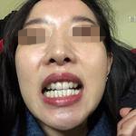 北京首都医科大学附属北京口腔医院董辉牙齿矫正案例分享