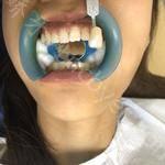 武汉仁爱口腔医院席明重牙齿矫正案例