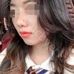 武汉德韩口腔医院杜静婷牙齿矫正案例