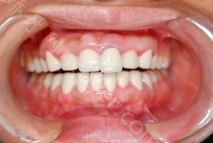 广东省人民医院口腔科胡艺博牙齿种植真实案例分享