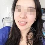 武汉存济口腔医院杜姣牙齿矫正案例