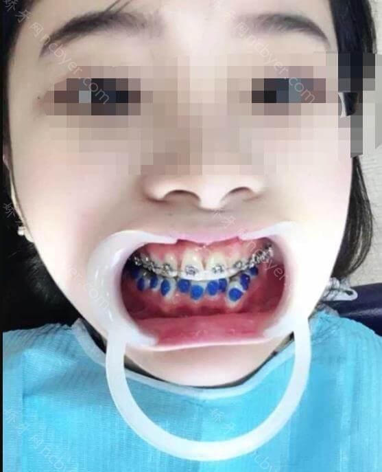 杭州余杭口腔医院宋宇涵怎么样？简介_案例介绍