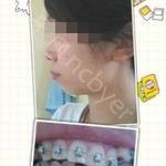 武汉优益佳口腔医院陶丽萍牙齿矫正案例展示