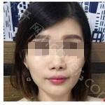 武汉优益佳口腔医院李明牙齿矫正案例展示