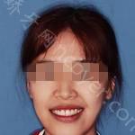 武汉优益佳口腔医院杨高峰牙齿矫正案例展示