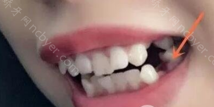 西安佳美口腔医院刘继乐牙齿矫正案例来啦！