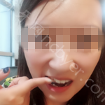 武汉虎泉口腔医院严凯牙齿矫正案例