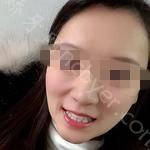 武汉虎泉口腔医院严凯牙齿矫正案例