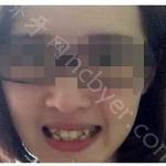 武汉大众口腔医院王小永牙齿矫正案例