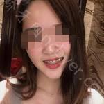 武汉大众口腔医院王小永牙齿矫正案例