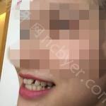 武汉同济医院陈卫民牙齿矫正案例分享