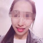 武汉同济医院口腔科朱声荣牙齿矫正案例分享
