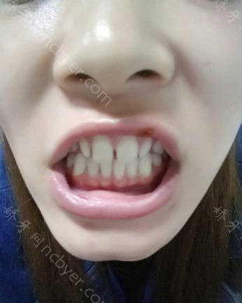 西安拜尔口腔门诊部赵淑贤烤瓷牙案例真实分享！