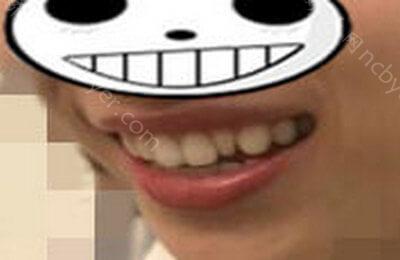 西安联邦口腔医院郭天文地包天矫正来啦！