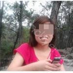武汉缀美口腔医院柯睿牙齿矫正案例分享