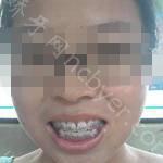 武汉缀美口腔医院柯睿牙齿矫正案例分享