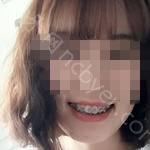 武汉缀美口腔医院万东元牙齿矫正案例分享