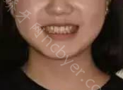 长沙利尔口腔门诊部冯梅芳牙齿矫正案例展示