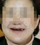 湖南省第二人民医院口腔科刘遵望种植牙案例展示