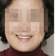 湖南省第二人民医院口腔科刘遵望种植牙案例展示