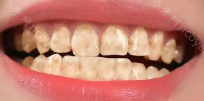 重庆牙管家口腔医院刘韬牙齿美白真实案例分享