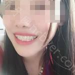 武汉第一口腔医院许庆安牙齿矫正案例
