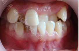 湖南省第二人民医院口腔科杨昭霞牙齿矫正案例分享