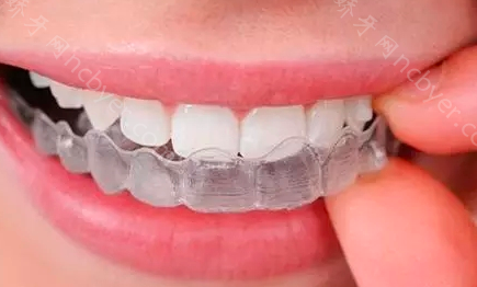 重庆华西牙科医院周星隐形牙齿矫正真实案例分享