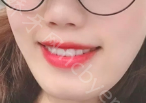 重庆牙卫士口腔医院吴建方牙齿美白真实案例分享