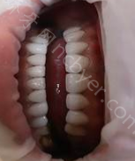 重庆贝尔口腔医院李健慧种植牙真实案例分享
