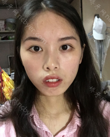 厦门拜博口腔医院张忠牙齿矫正案例展示
