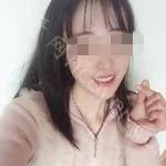 武汉博雅口腔医院孙凤颜牙齿矫正案例分享