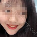 武汉博雅口腔医院关忠玉牙齿贴面真实分享