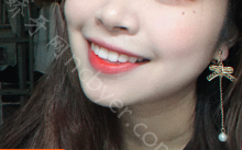 重庆华美口腔医院王威牙齿美白真实案例分享